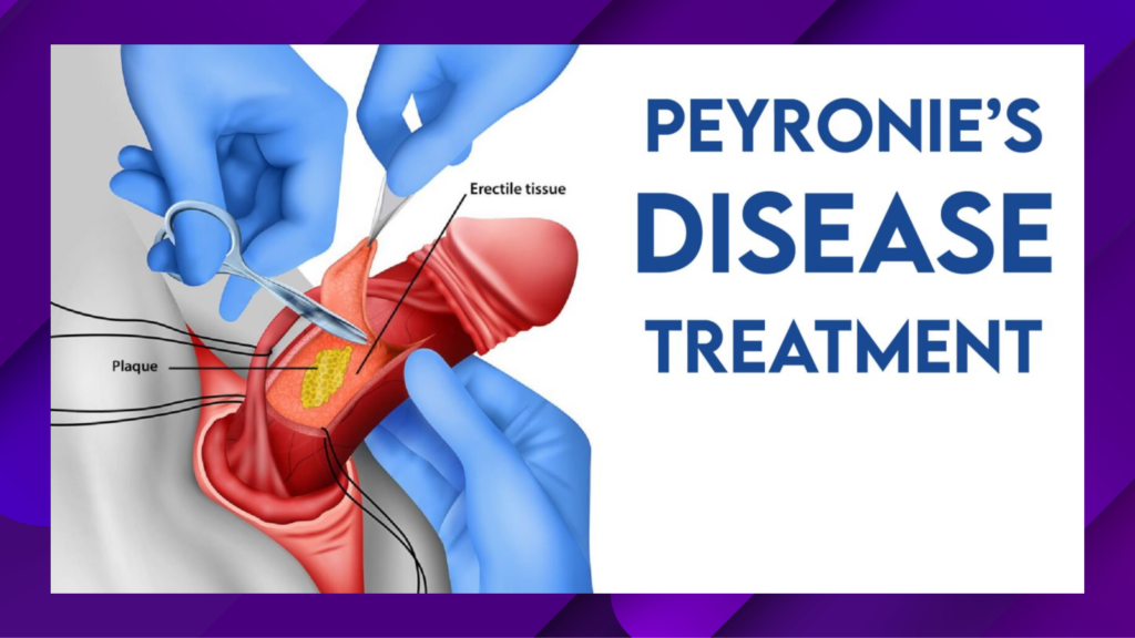 peyronie's disease treatment 2023